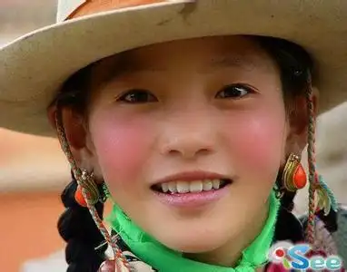 高原红-医学疾病名词图片