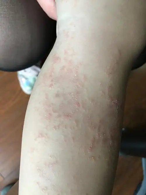 是一种以线状排列的多角形丘疹为典型皮损的慢性炎症性皮肤病