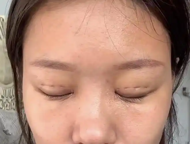 多点定位埋线双眼皮图片