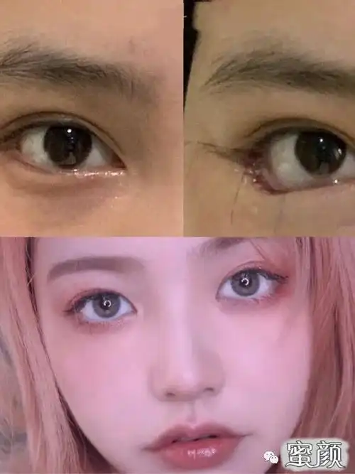 美然眼睑下至芭比眼