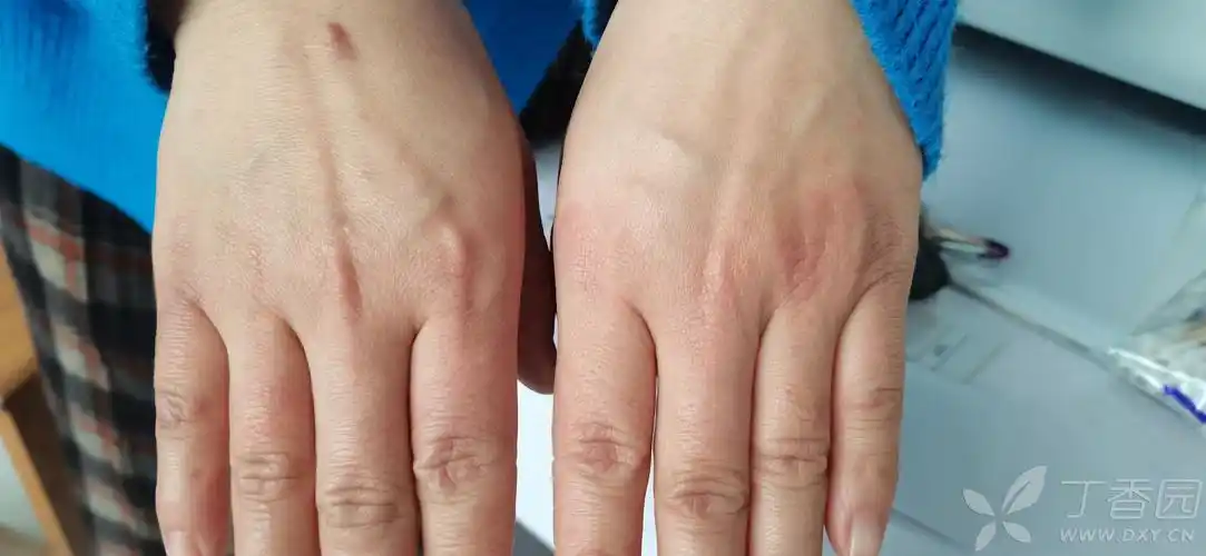 亚急性皮肤型红斑狼疮一例