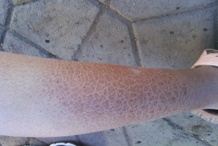 治疗鱼鳞病的小偏方——蛋黄油