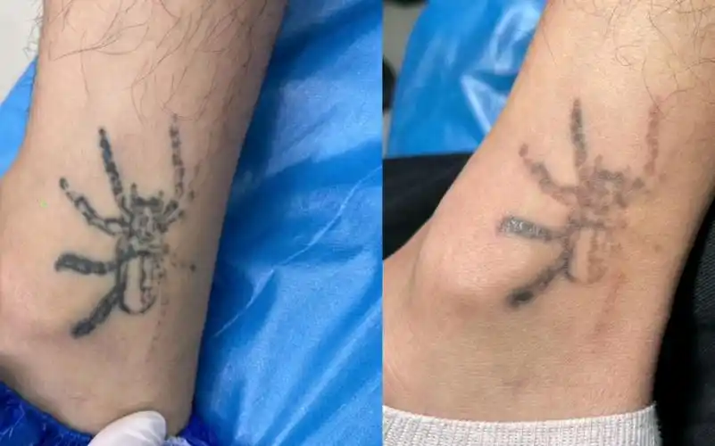 济南洗纹身效果一次对比