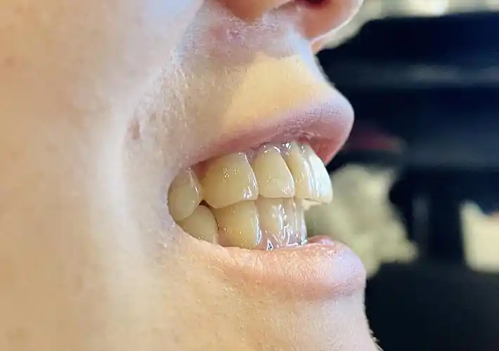 最后附上我的牙齿正面和侧面… 我是肯定要戴牙套的了!