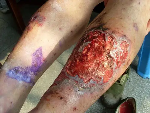 恐怖的溃疡 - 皮肤及性传播疾病讨论版 - 爱爱医医学论坛