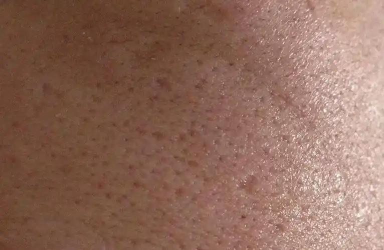 你的毛孔为什么这么大?_皮肤