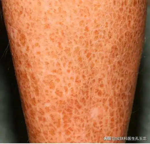 皮肤科常见疾病系列:小腿长的像鱼鳞一样的东西是什么