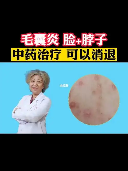 毛囊炎脸加脖子中药治疗可以消退