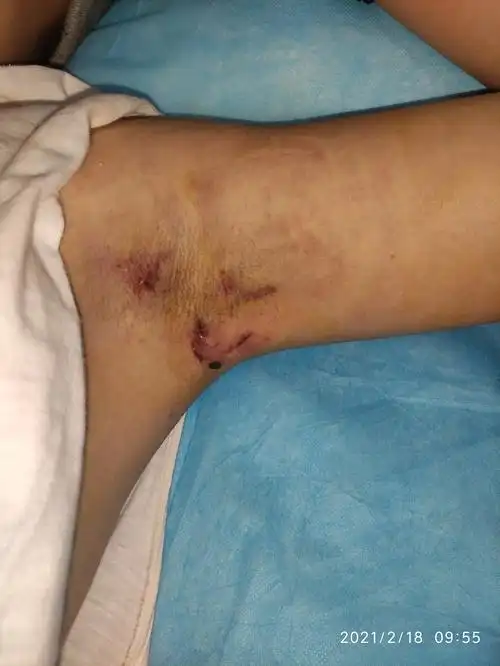 腋臭的微创综合治疗方法: - 好大夫在线