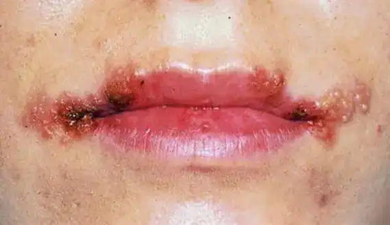 孩子烂嘴角长口腔溃疡是上火了吗