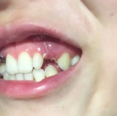 六颗种植牙两个月反馈