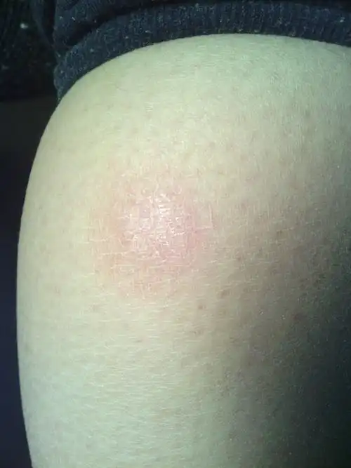 女性,双小腿肚分别起来一个大约一元硬币的东西,发红,微疼,上传了图片