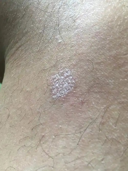 腿上起一片片的 有白皮 扣掉后又出来 抠的时候有点痒