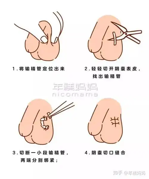 婚后避孕到底是女方带环好还是男性结扎好