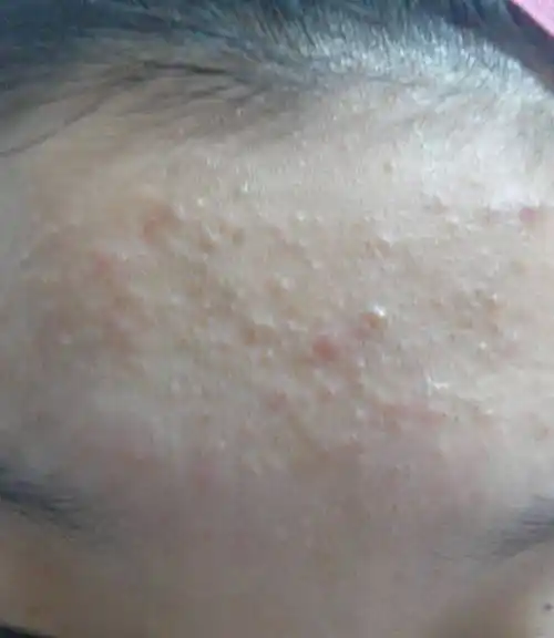 额头上面长了很多东西 毛孔应该也有点堵塞 图片照出来特别吓人呜呜呜