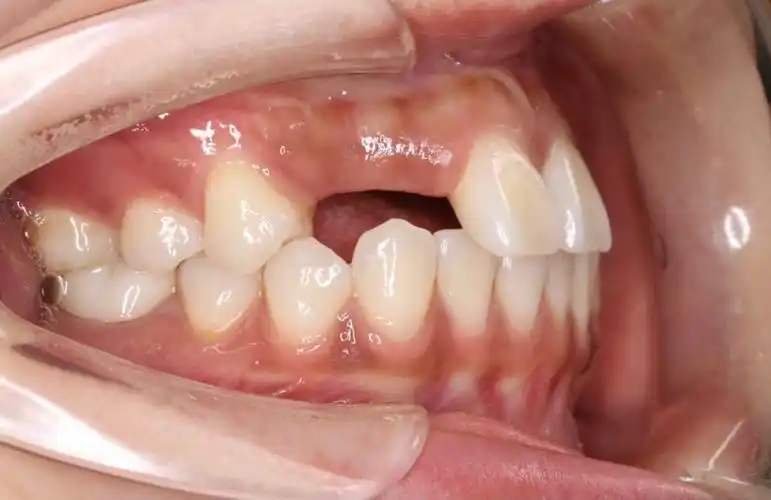 牙齿缺失要及时修复,否则..._朱凌肃__爱问健康