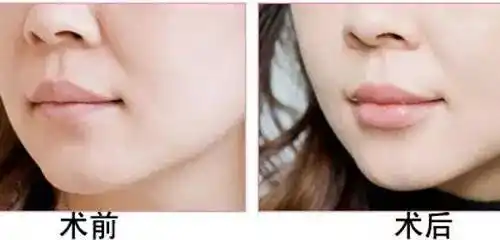 女神们你和性感嘟嘟唇只差一支玻尿酸