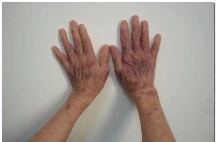 全世界其实对红斑狼疮都是保守治疗,即使最新的sle治疗法也不一定适用