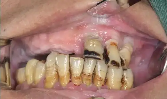 吕大哥长期吸 烟口腔卫生差.65岁吕大哥牙齿缺失多年,口腔卫 - 抖音