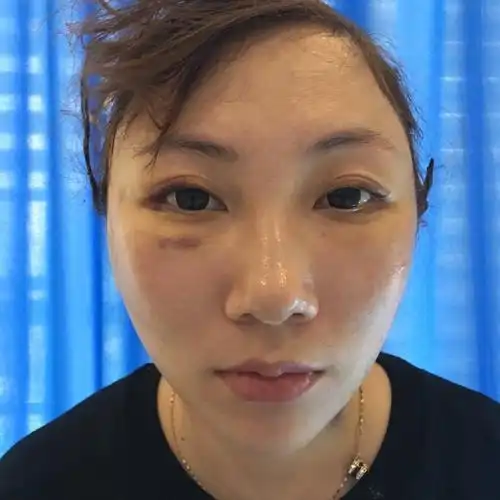 拉皮 术后第七天,能够看到皮肤这几天变得越来越好了,才做完手术的