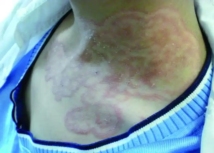 皮肤性病科图谱: 真菌性皮肤病 叠瓦癣