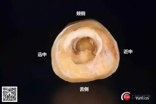 图解c形根管形态,分类及治疗-口腔专家-云看牙