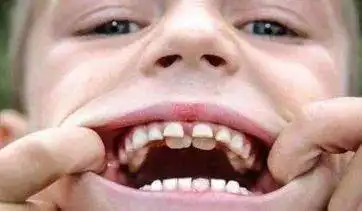 "每一天学一点活动"——(125)双排牙