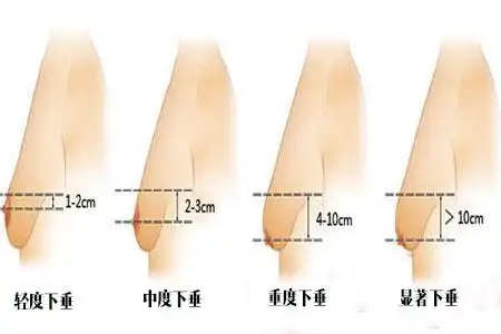 为什么断奶后胸部更容易萎缩下垂?