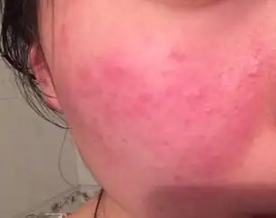 脸上形成皮肤过敏的原因_脸部皮肤过敏_青岛皮肤病研究院