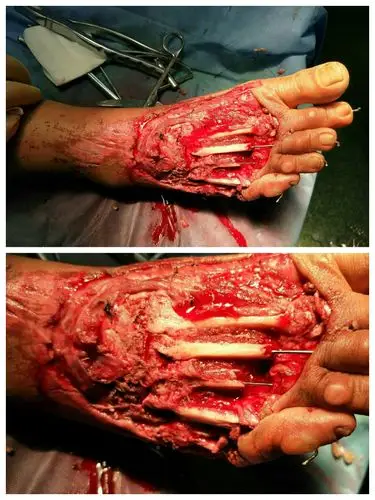 术中清创,内固定术后,骨质缺损外露,皮肤,软组织,肌腱缺损.