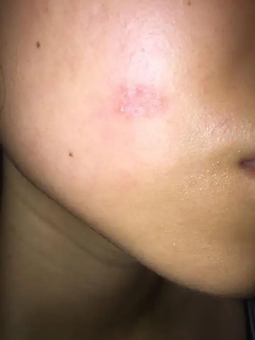 请问有没有知道我脸上长得这个是癣吗?