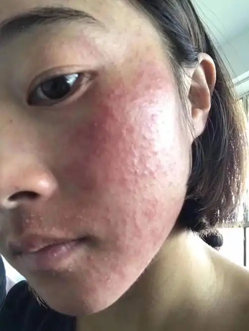 脸部红肿,痒痛,干燥,起皮各类过敏问题经验