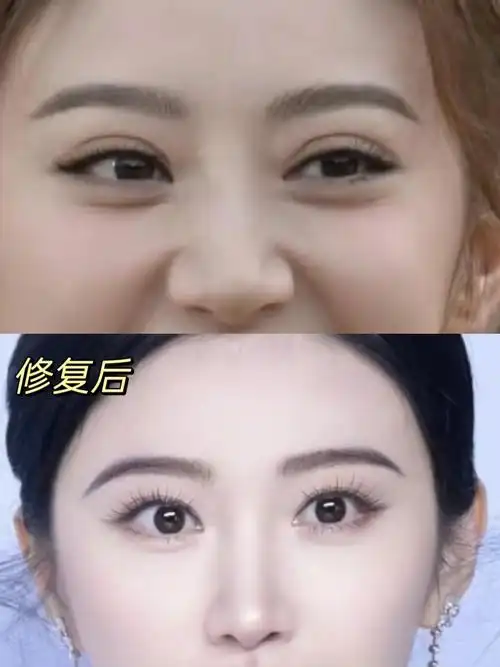 人间富贵花景甜为什么修窄双眼皮?