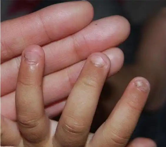 孩子咬指甲总咬出血?并非缺维生素这么简单,这4个原因是关键