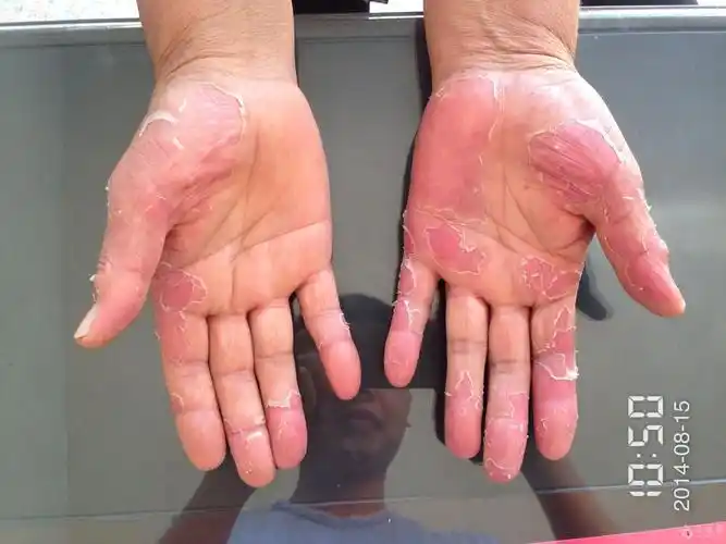 双手严重蜕皮数年,高清图片送上 - 皮肤及性传播疾病讨论版 - 爱爱医