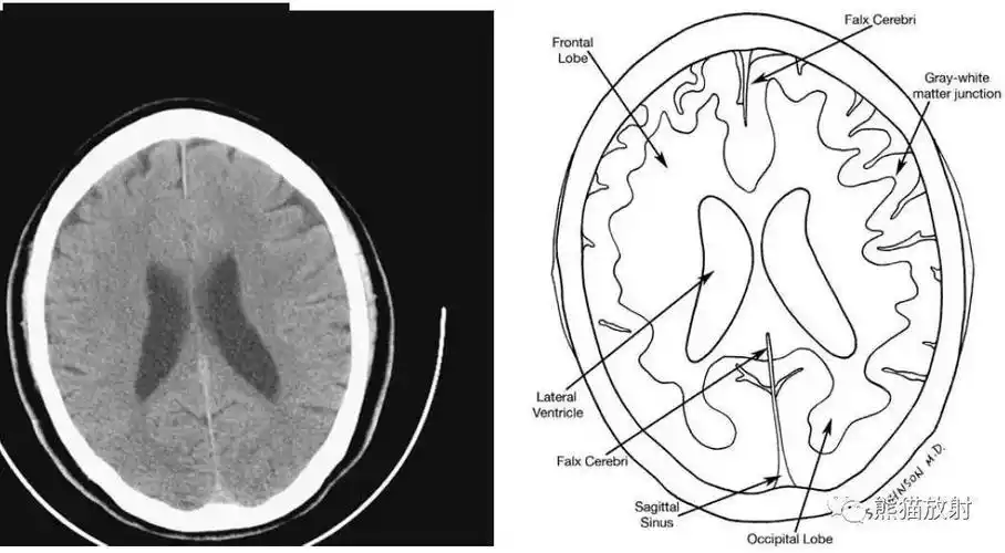 颅脑ct的正常解剖