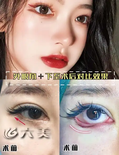 为什么有人做完眼睑下至手术没有变美反而变丑了