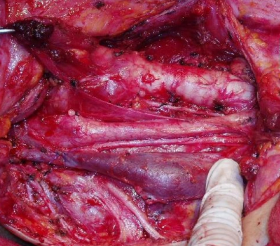 新北市淋巴瘤专家_新北市治疗淋巴瘤哪个专家好_新北市治疗淋巴瘤最好