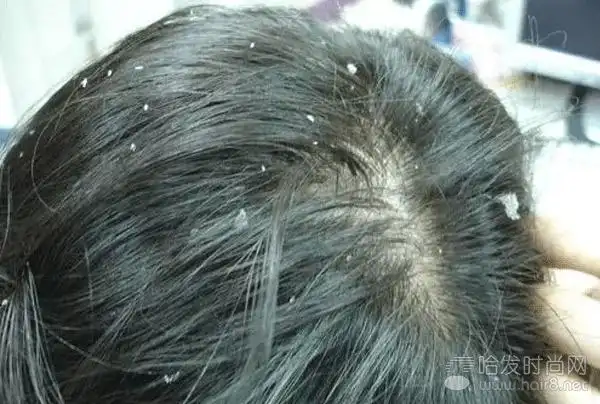 "注氧保湿"系列,干性头皮屑的克星!