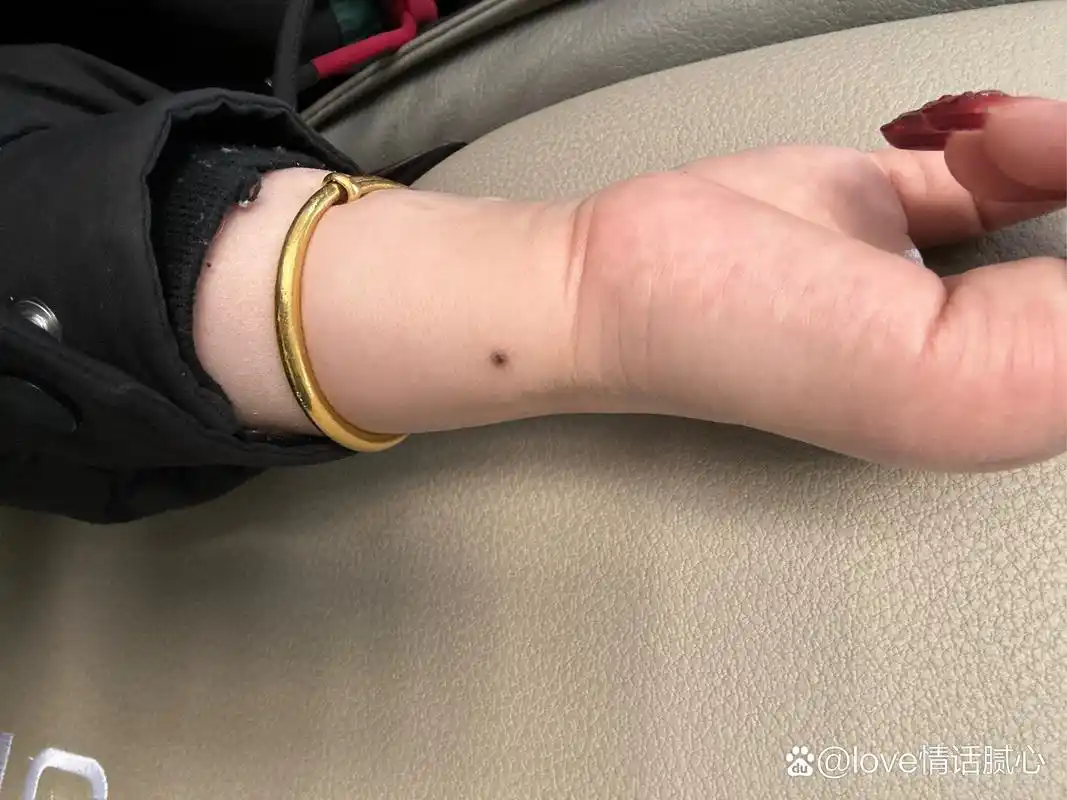 手腕处的这颗痣好吗?