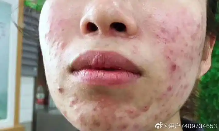 护肤英子秘籍之激素性皮炎导致角质层长期的受损该如何修复有哪些对策