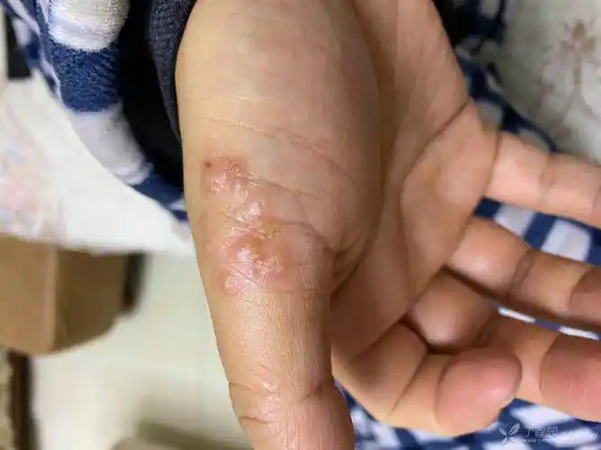 请教皮肤科老师们这是什么皮疹