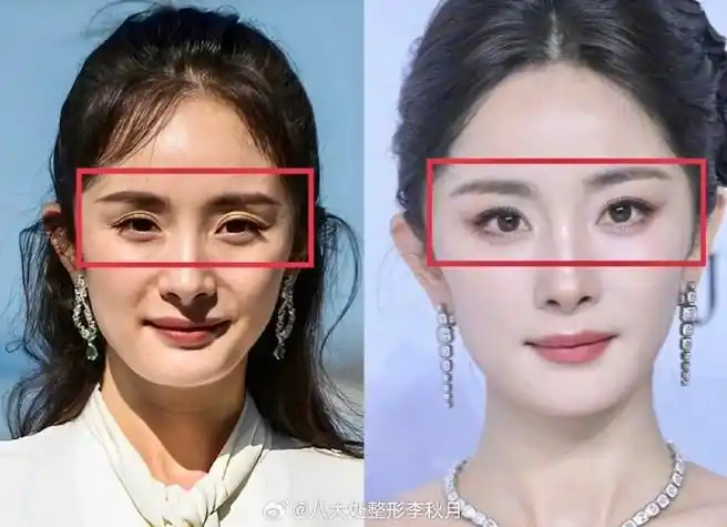八大处李秋月##北京双眼皮##眼窝凹陷##眼窝凹陷填充##杨幂##杨幂