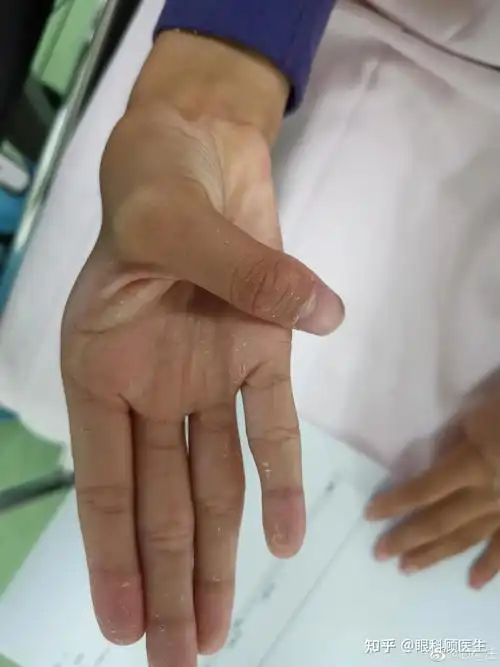 会失明的马方综合征