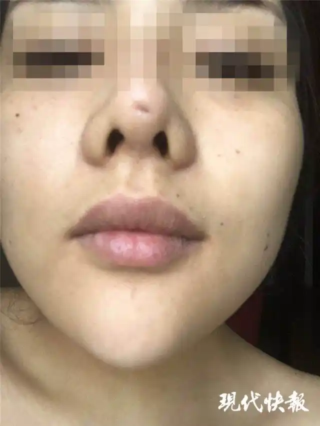 南京怡华医疗美容医院整形失败 90后姑娘隆鼻后成了"猪鼻子"