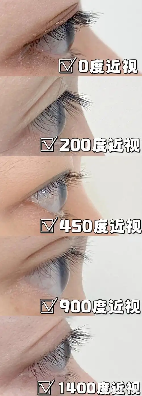 从0度近视,低度近视,中度近视,高度近视和超高度近视的眼球进行对比