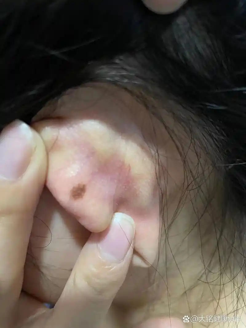 耳朵后面长了颗痣,要不要切 耳朵后面突然长了颗痣,感觉有点大,有没有