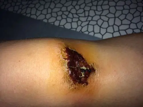 什么药使伤口留下的疤痕小或者没有疤痕?