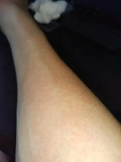 手臂上长了红色的籽籽,这是皮肤过敏吗,基本每年都要长,是怎么回事