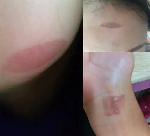 有时候困了,一个不注意就会让直板夹烫到自己脸上和胳膊上,只是烫红